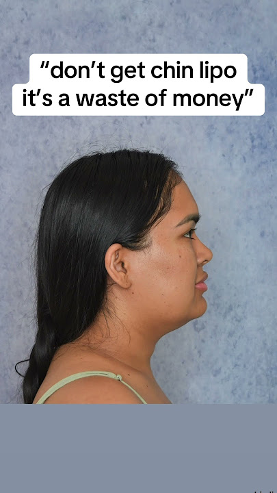 INSANE chin lipo results 😱🔥 #chinlipo #chinliposuction #plasticsurgery #glowup #jawline #snatched