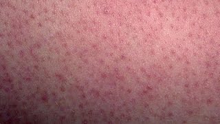 HOW TO GET RID OF CHICKEN SKIN ON ARMS, THIGHS AND BUTT: KEROTOSIS PILARSIS DML style