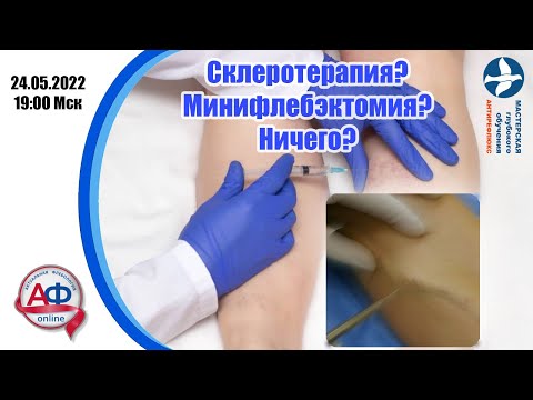 Склеротерапия? Минифлебэктомия? Ничего?