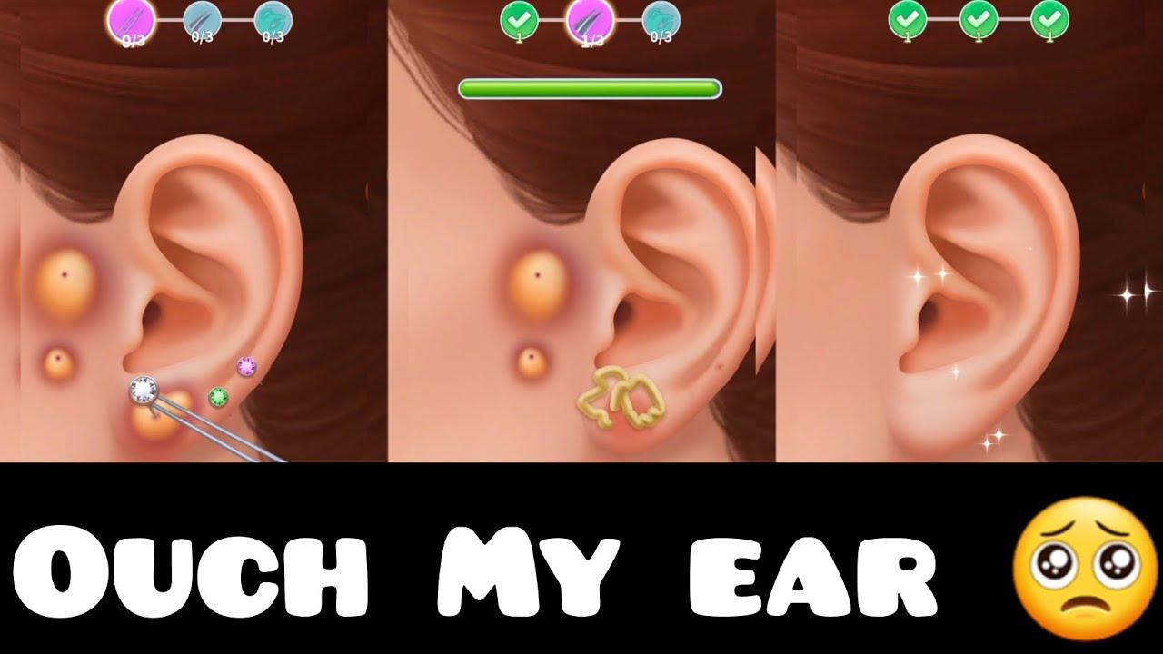 ASMR ear waxing ear pimple popping most satisfying video ever 