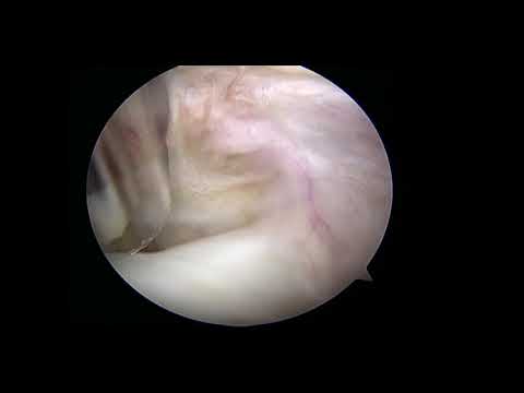 McLaughlin Procedure | Hill-Sachs Lesion | Arthroscopic Shoulder Surgery