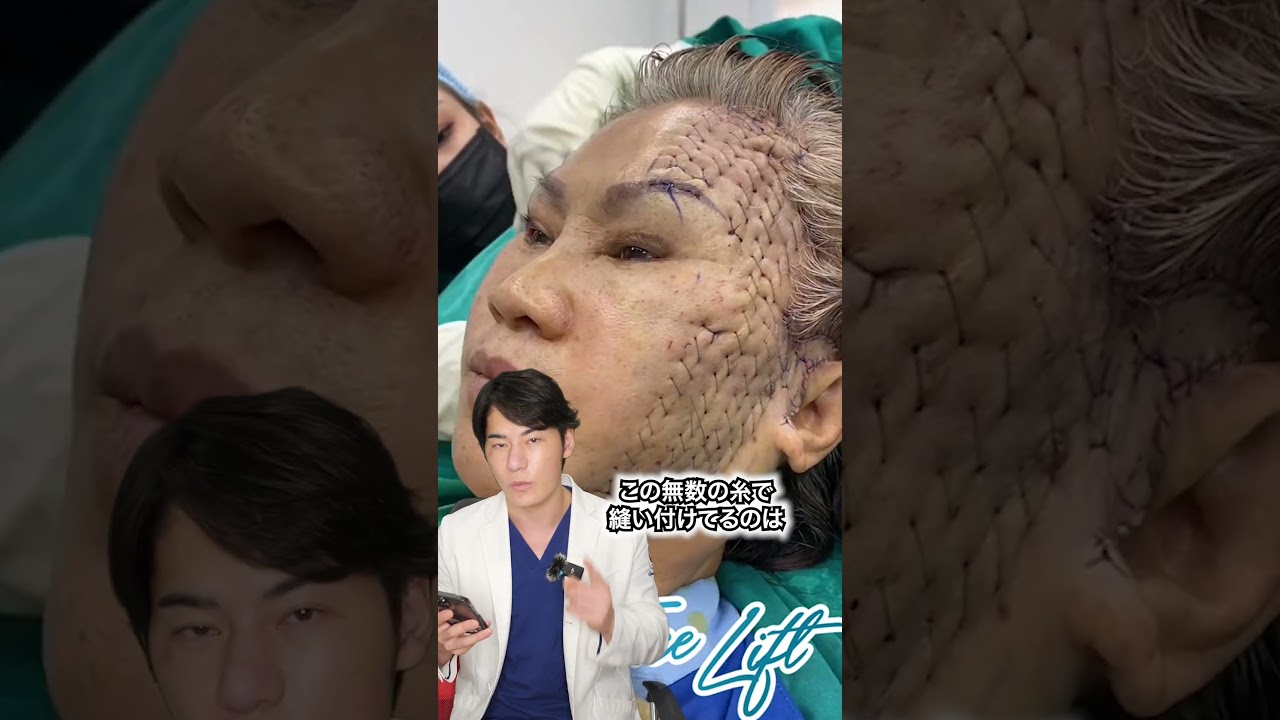 整形失敗...? やばいフェイスリフト #shorts