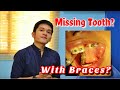 MISSING TOOTH WITH BRACES