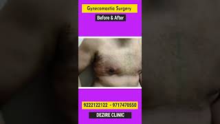 Gynecomastia Result After 7 days. Gyno POST OP Result #shorts