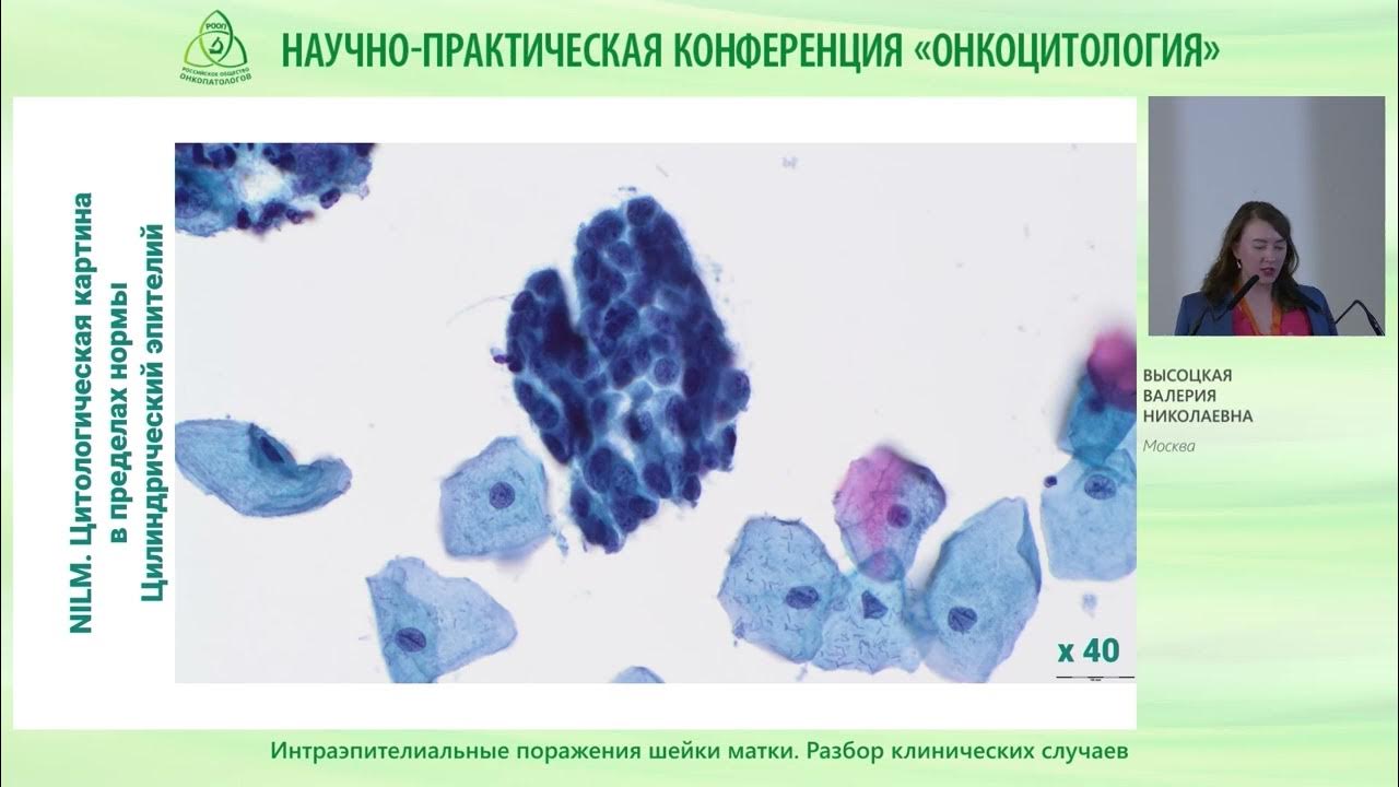 Что означает интраэпителиальное поражение. Сквамозные интраэпителиальные поражения. Интраэпителиальные лейкоциты в кишечнике. Интраэпителиальные изменения плоского. Интраэпителиальная Нео.