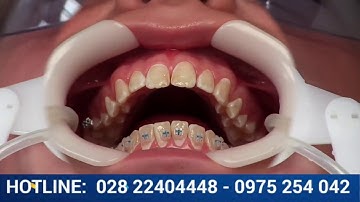 Cận Cảnh Quy Trình Niềng Răng Mắc Cài Pha Lê - Nha Khoa City Smile