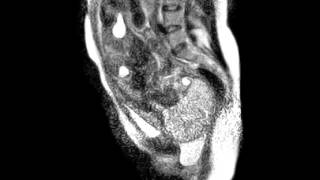 Video: Human birth in an MRI