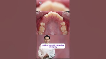 Niềng Răng Kì Diệu Như Thế Nào ? - Bác Sĩ Tài Tử Tế #bacsitaitute #niengrang #nhakhoauytin