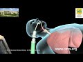 Intubation and Mechanical Ventilation (Hindi) - CIMS Hospital