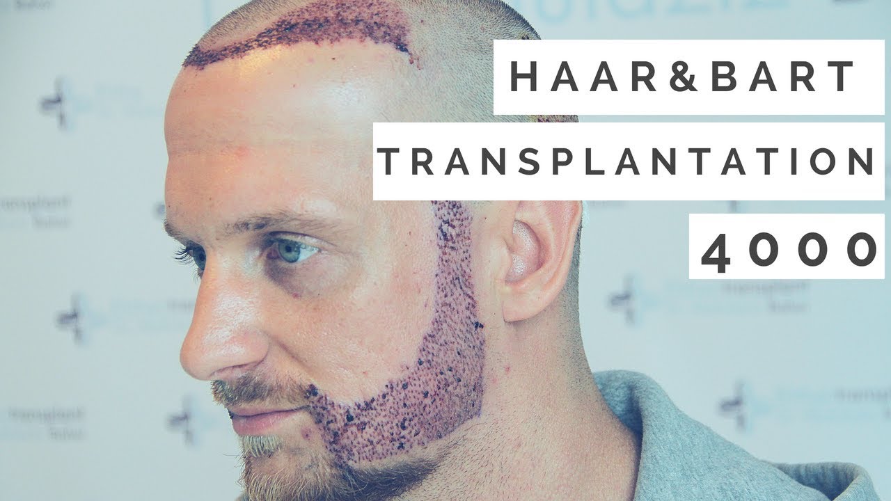 Haartransplantation Und Barttransplantation In Istanbul Erfahrung YouTube