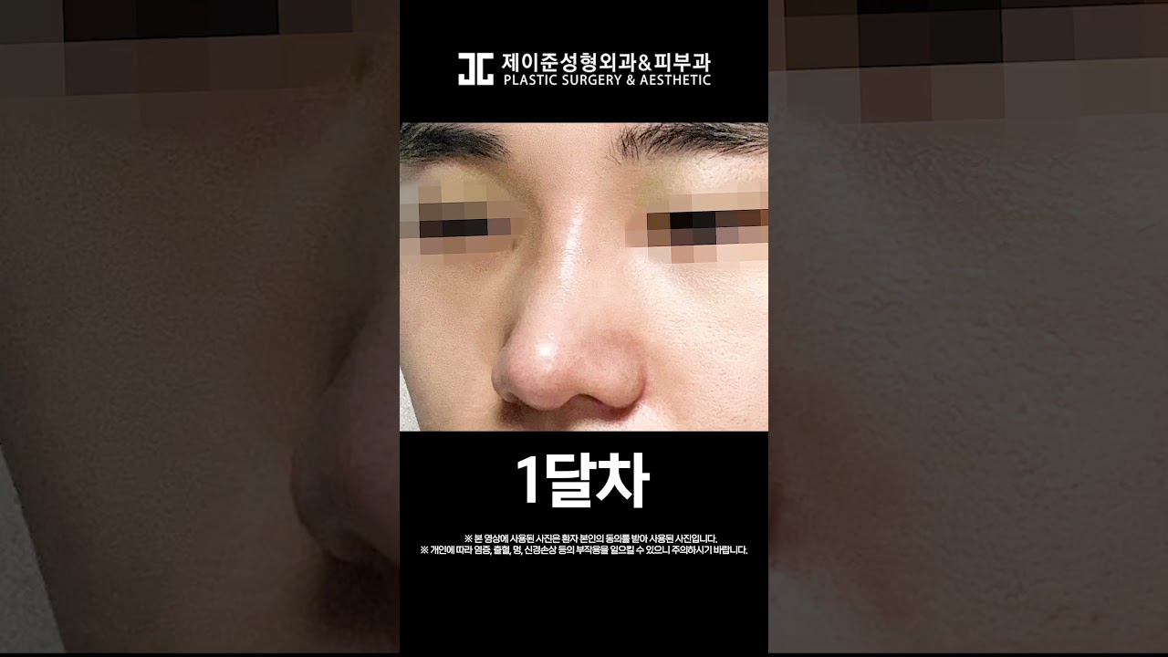 [Thẩm mỹ viện Jayjun] Nâng sống mũi gồ ghề 빡💥 nâng đầu mũi chảy xệ 촉💥 so sánh trước và sau phẫu thuật 👃 #shorts