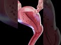 Adenomyosis 3D Uterus Animation