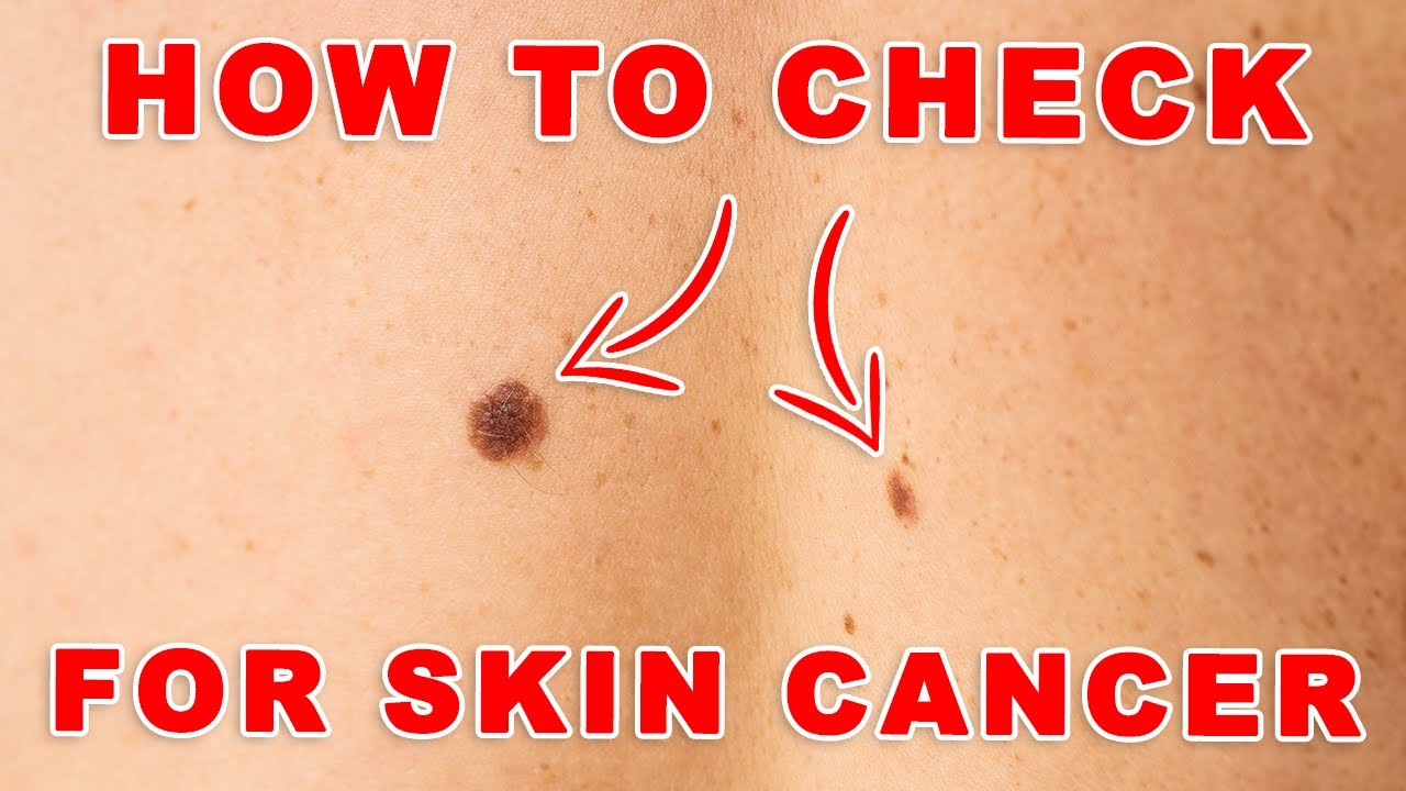 Don't Ignore the Signs: Understanding Melanoma and Skin Cancer - YouTube