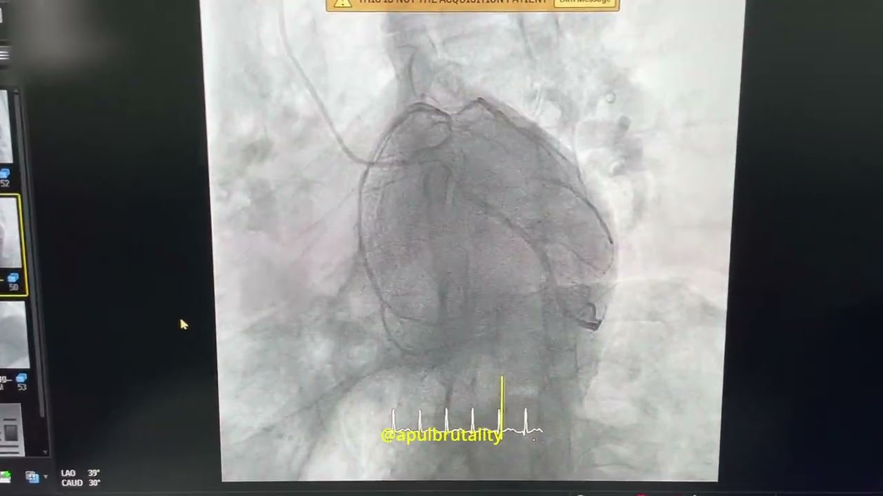 Basic coronary angiography views