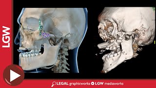 Maxilla Reconstruction Surgery 3D Animation