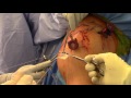 Dr. Frisella Superior Capsular Reconstruction : Improved Tensioning Technique