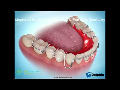 Lower Removable Retainer with Metal Bow | City Orthodontics & Pediatric Dentistry Edmonton