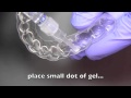 How to use and maintain custom teeth whitening trays by Helm | Nejad | Stanley - Dentistry