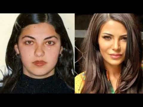 ქართველი ლამაზმანები პლასტიკურ ოპერაციამდე და შემდეგ