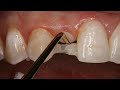 Direct resin bonded bridge  dental online training