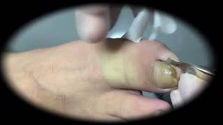 Ingrown Toenails Treatment Satisfying Pedicure Manicure #5