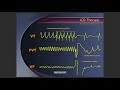 Pacemaker icd programming  troubleshooting defibrillator cardiacdevice cardiology cied