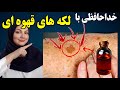 درمان همیشگی لکه های قهوه ای و سفید روی صورت دست گردن و بدن پوستی روشن و صاف بدون لکه داشته باش