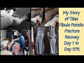 My fracture story full story of survivalwithnitin day 1 to day 575  walk after implant removal