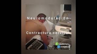 Tratamiento con neuromodulación de una contractura cervical