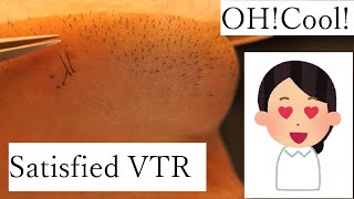 Extractions Unwanted Hair Satisfied ASMR Hair Removal  l Tweezers Beard l 2021/12/28