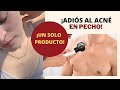 ¡ADIÓS GRANITOS EN PECHO CON UN SOLO PRODUCTOS! EN DOS SEMANASSSS!