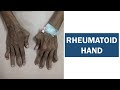 Rheumatoid Hand (Rheumatoid Arthritis Hand Deformities)