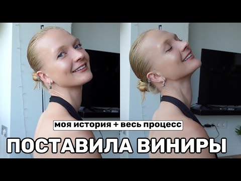 ПОСТАВИЛА ВИНИРЫ В СТАМБУЛЕ, ТУРЦИЯ | весь процесс и результат