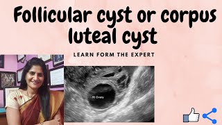 What Is Follicular Cystwhat Is Corpus Luteal Cyst