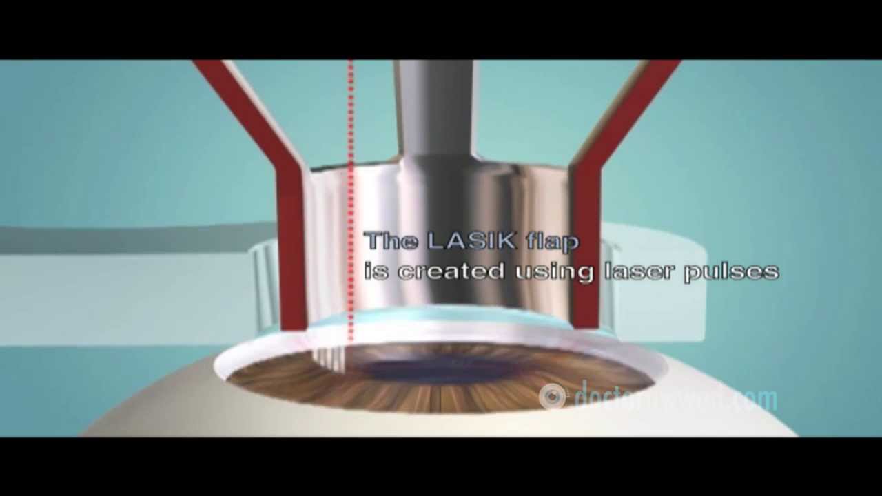 FemtoLASIK (aka IntraLASIK or bladeless LASIK) (Arabic)