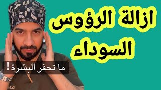 ازالة الرؤوس السوداء من الوجه بالكريمات دكتور طلال المحيسن