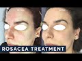 Treating Rosacea with IPL