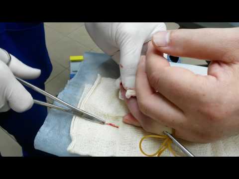 Удаление спицы из пальца после перелома - YouTube