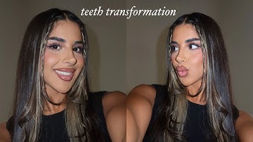 MY TEETH TRANSFORMATION... Invisalign, whitening + composite edge bonding