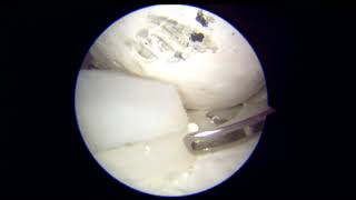 Download Lagu ACL loose body | Arthrolearn Workshop | Al Arif Hospital Trivandrum MP3 Download Lagu ACL loose body | Arthrolearn Workshop | Al Arif Hospital Trivandrum MP3
