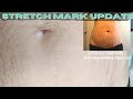 Stretch Mark Update! | Car Accident | Avologi Eneo Advanced