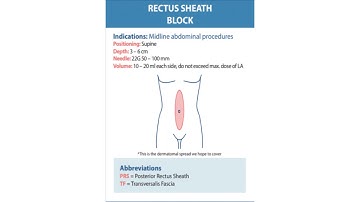 Rectus Sheath Block #Anaesthesia