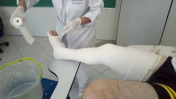Quanto tempo demora para secar o gesso na perna?