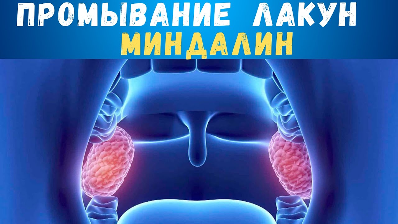 Промывание лакун миндалин ручным способом #миндалины #тонзиллит # ...