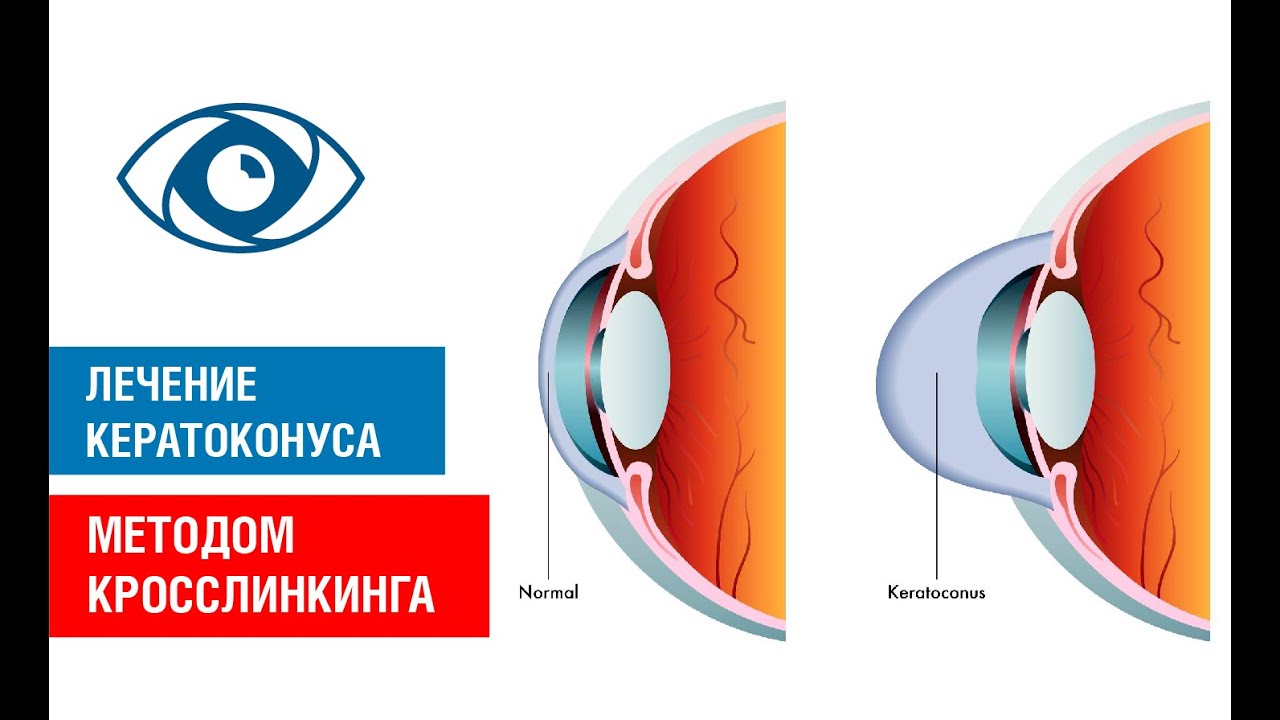 ЛЕЧЕНИЕ КЕРАТОКОНУСА МЕТОДОМ КРОССЛИНКИНГА