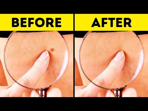 Video: How To Get Rid Of Papillomas At Home Quickly And Effectively
