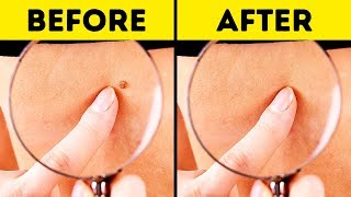 10 Effective Ways to Remove Skin Tags Naturally