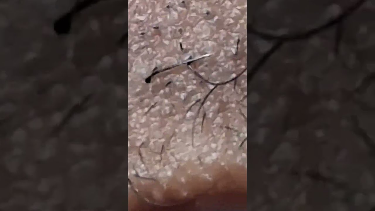 Beard Hair Pluck ASMR Ultra Close Up Root Reveal