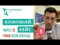 Рак простати після успішної операції 13 років тому - рецидив, онкомаркер вище норми в 450 разів!