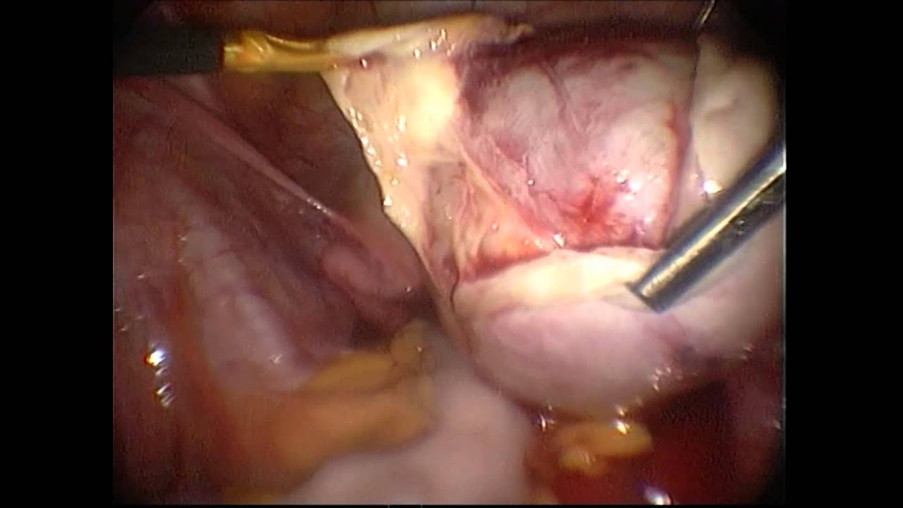 Dermoid cyst